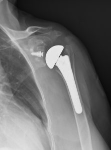 Shoulder Replacement In Seattle WA | Dr. Samuel Koo