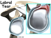 labral tear surgery in seattle