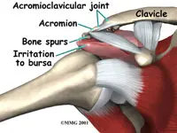 shoulder impingement treatment