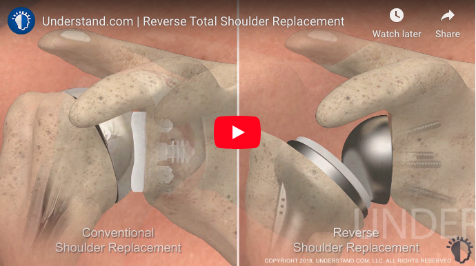 Dr. Koo's Shoulder Surgery Education Videos