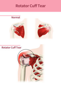 Rotator Cuff Tear Treatment in Seattle, WA | Rotator Cuff Repair