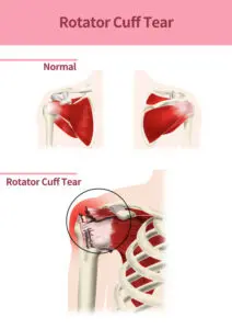 rotator cuff surgery in seattle